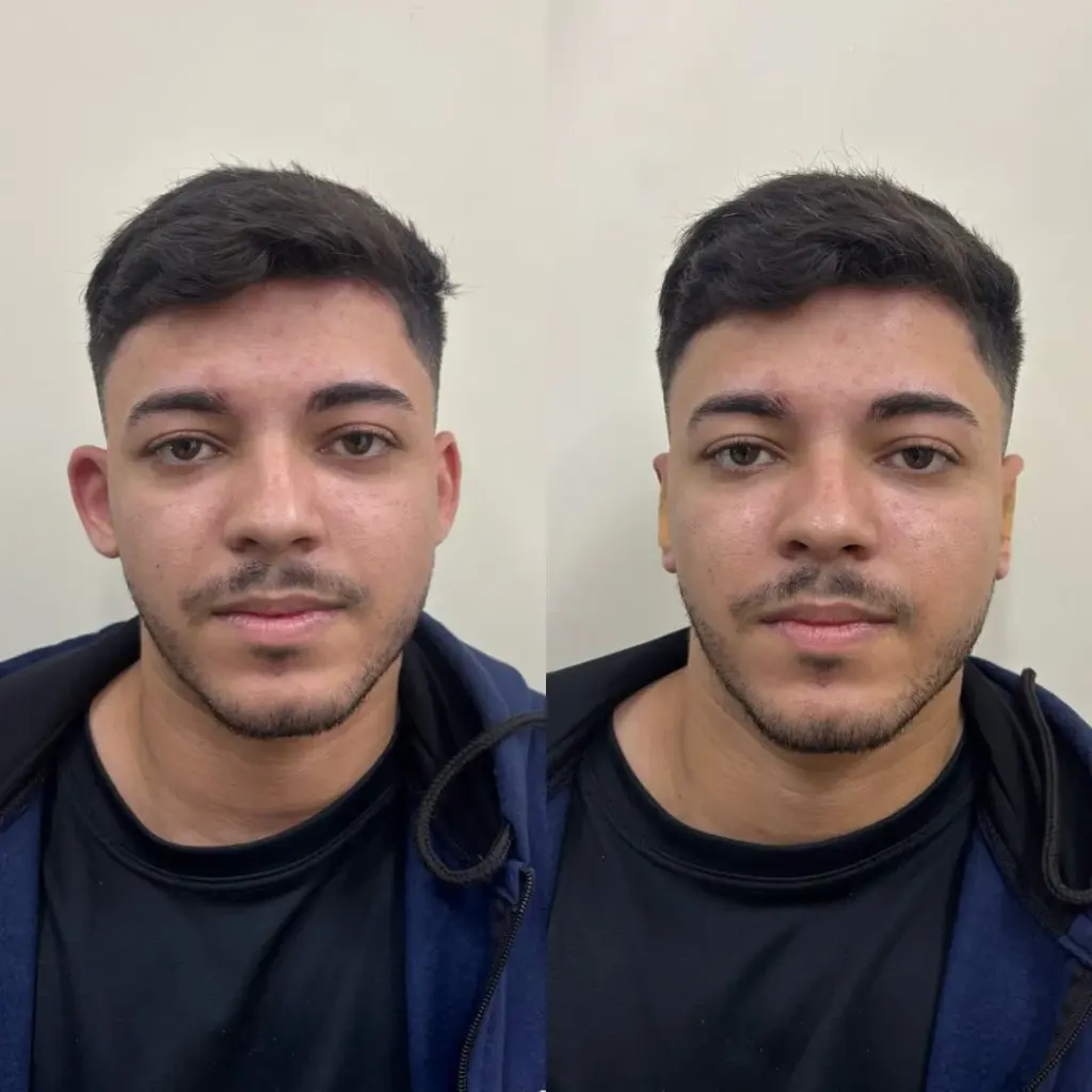 correção de orelhas com especialista