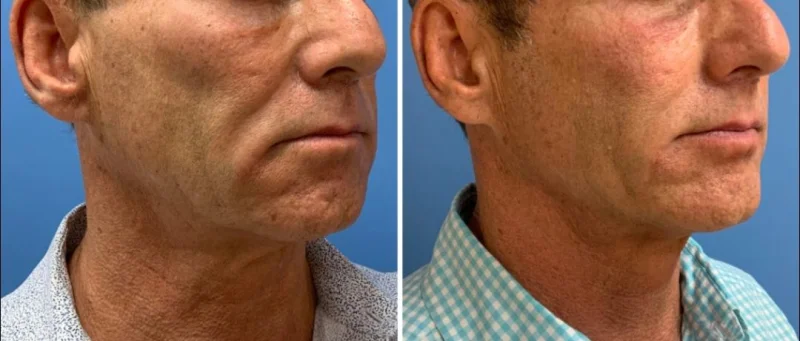 bioestimulador de colágeno corporal