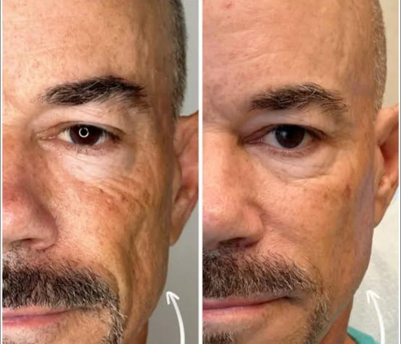 bioestimulador de colágeno injetável