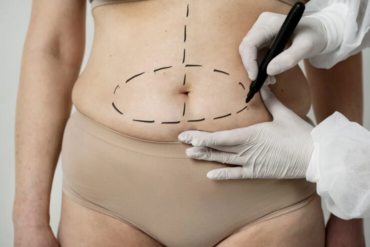 bioestimulador de colágeno barriga