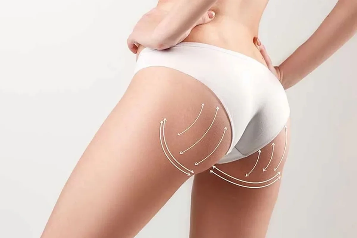 bioestimulador de colágeno no bumbum
